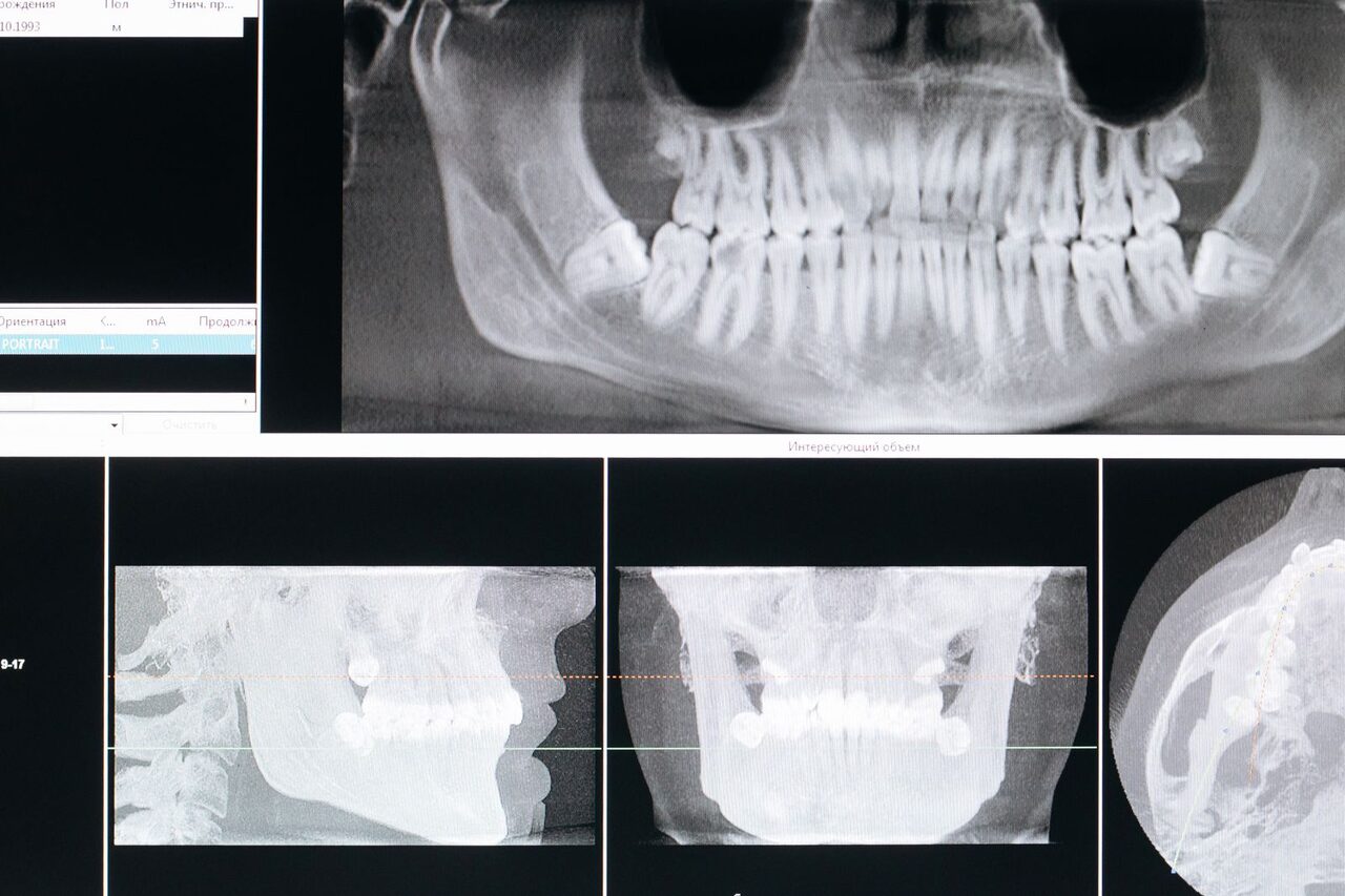 En esta imagen, vemos una radiografía dental panorámica u ortopantomografía