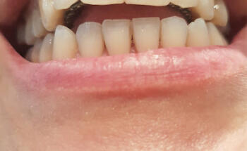 Lingual Orthodontics Apoquindo