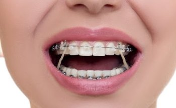 Implantes dentales en Tijuana - DENTOK México