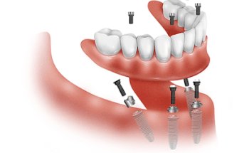 Implantes Dentales 3D
