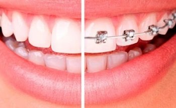 Dentista En Puebla - Urgencia Dental - Clinica Aiteli