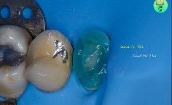 druizclinik prótesis bucal e implantología