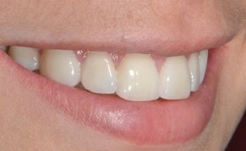 REHABILITACIÓN BUCAL