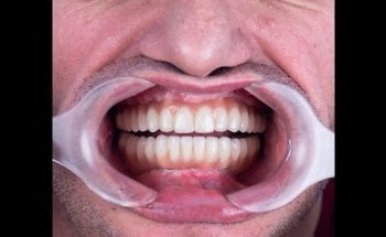 CEID Clínica Dental Barcelona | Implantes dentales | Carillas dentales | Ortodoncia