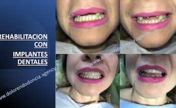 IMPLANTES DENTALES ( UNA SONRISA DE PERLAS ES POSIBLE)