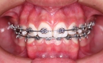 DENTAL CROWN