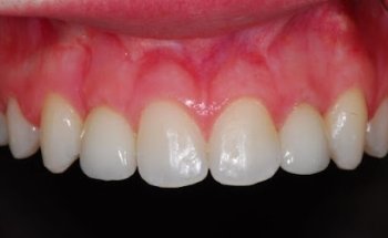 Smile Design - Dental implants Christchurch