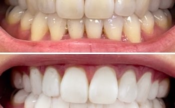 Lovelysmiles Teeth Whitening Newmarket (Temp Residential Clinic)