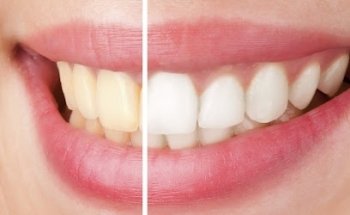 Sparklewhite Teeth Christchurch