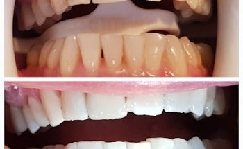 Niho Ma Teeth Whitening & More