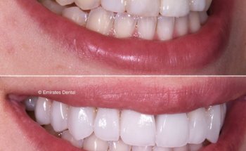 Emirates Dental - Cosmetic Dentistry & Invisalign Clinic Dubai