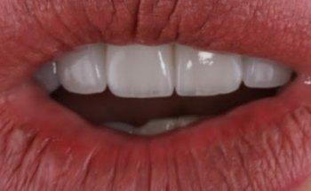 ICONIC SMILES - Porcelain Veneers Sydney