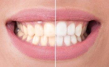 Pain Free Dentist Sydney - Dentist Dulwich Hill, Hurlstone Park NSW