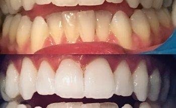 Bondi Bright Teeth Whitening