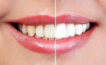 Beauty By Suelle Teeth whitening and tooth gems
