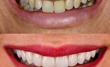 Friends Dental Practice - Accepting New Private Patients |Composite Bonding |Invisalign |Implants |Emergency Dentist Norwich