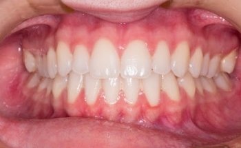 Clínica Dental Dentart Barcelona. Dentista de urgencias, ortodoncia invisible, implantes en el centro de Barcelona.