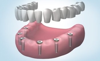Clínica Dental Implantdent Empuriabrava