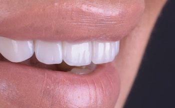 Dr. Bruno Pereira Estética dental