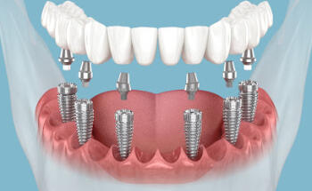 South Central Dental Implants