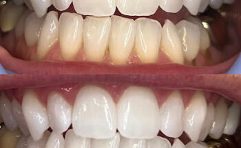 Soft Touch Teeth Whitening