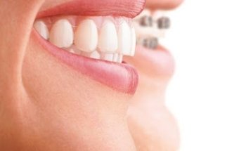 Invisalign | Clínica Max Dental Móstoles | Implantes | Blanqueamiento Dental