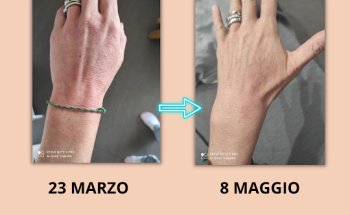 Dermatite atopica e nutrizione_ Dr.ssa Maria Innocente