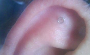 Nutrizionista a Torino - Auricoloterapia Dottor Fatiga - Fame nervosa