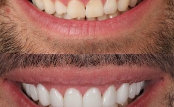 DRMR Clinic | Veneers London