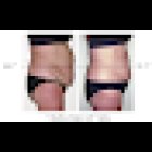 Maryland Laser Weight Loss