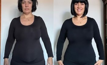 Clínica de Medicina Estética MINERVA PEYÚS. CARBOXITERAPIA - BRUXISMO - MICROBLADING - LASER - VELLO BLANCO